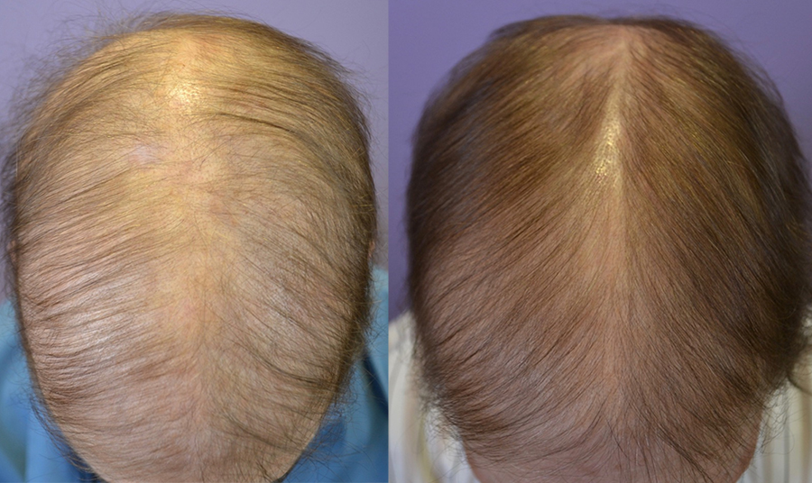 Severe Alopecia After Chemotherapy Hair Restoration Of The South