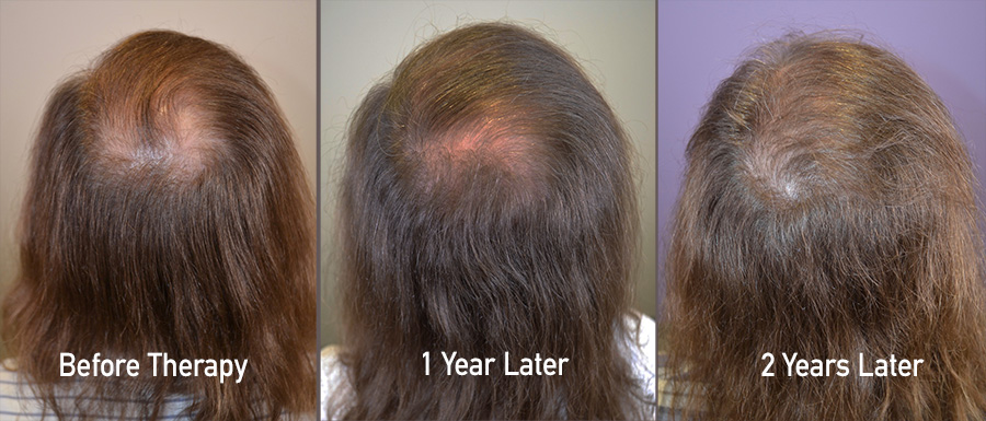 crown hair loss Archives - Hair Restoration of the South