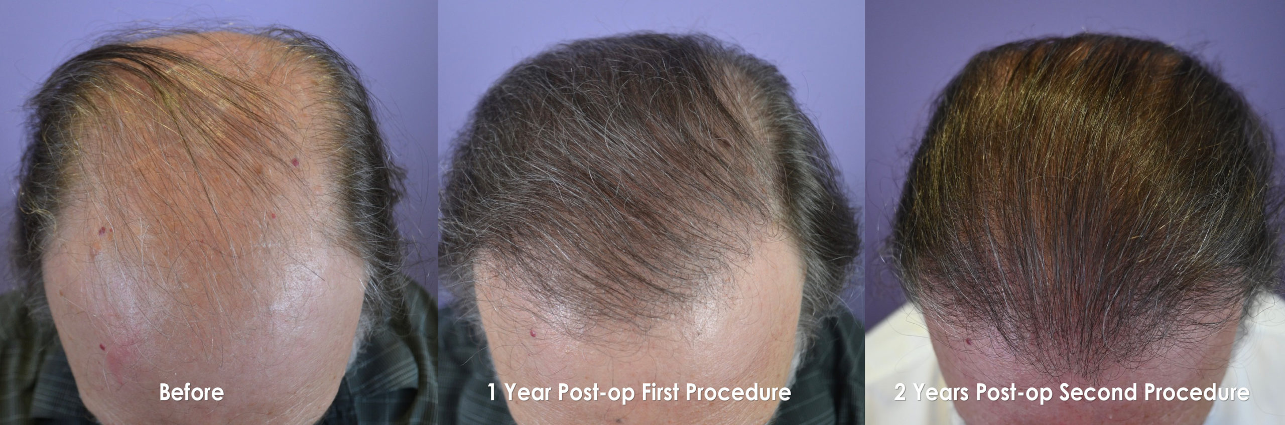2 Procedure FUT Hair Transplant on a 70 Year Old Male - Hair Restoration of  the South