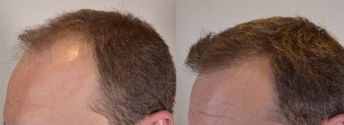 Left side view - hair line restoration. 