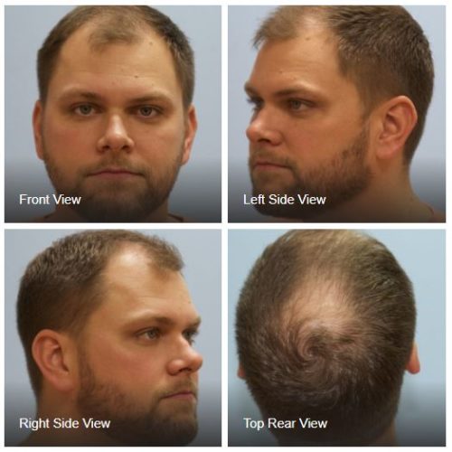 Submit your photos Hair Restoration of the South New Orleans, LA