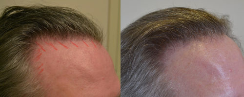 50 year old male with hairline restoration - 1650 grafts hairline and crown.