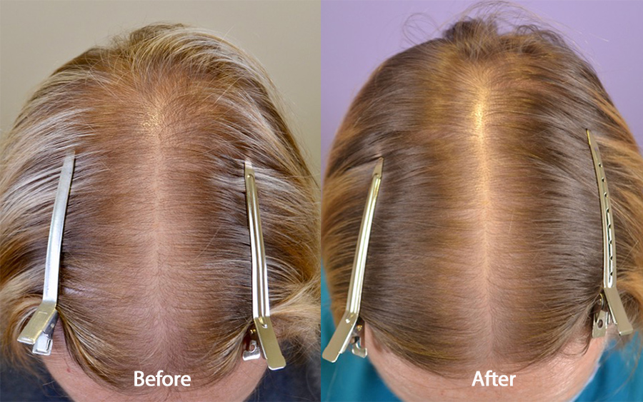 Spironolactone (For Females only) Before & After Photos - Hair Restoration  of the South - New Orleans, LA