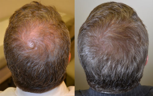 55 year old male with hair loss in the crown. The hair loss was not significant and Dr. Rogers prescribed Propecia 1mg -finasteride - 1 tablet daily over the course of 2 years the crown area has completely filled in.