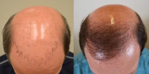 Hair Transplant Before and After Photos: Men - Hair Restoration of the  South - New Orleans, LA