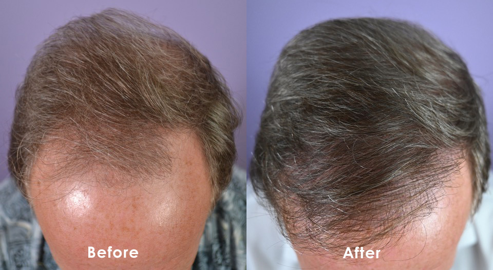 Hair Transplant Case Study - 60 Year Old Male - Mature Hairline - Hair  Restoration of the South