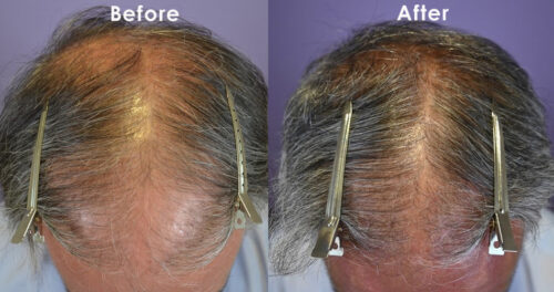 oral minoxidil 5mg daily, and finasteride 1mg daily