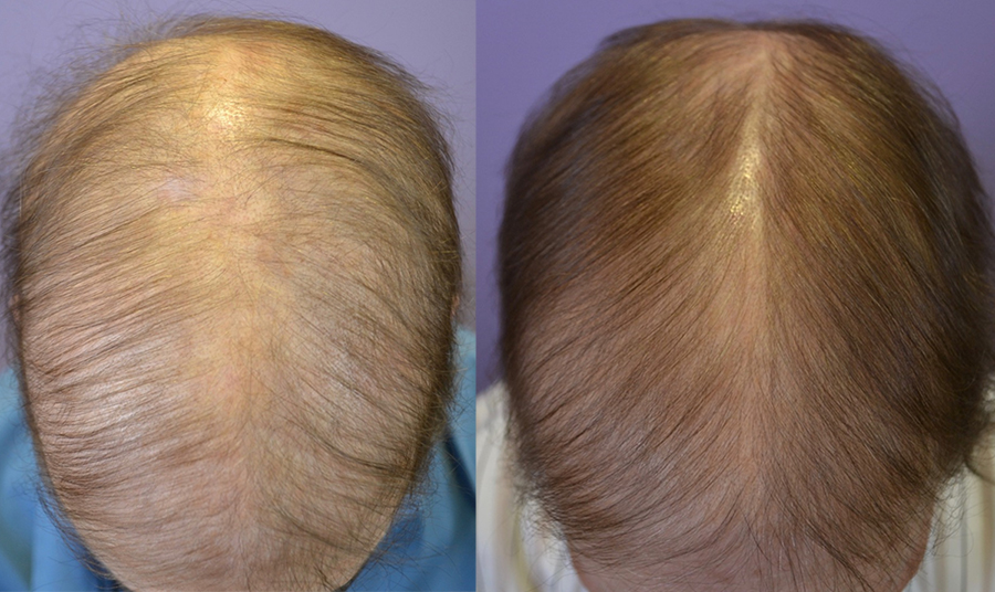 Severe Alopecia after Chemotherapy - Hair Restoration of the South Severe Alopecia after Chemotherapy - Hair Restoration of the South