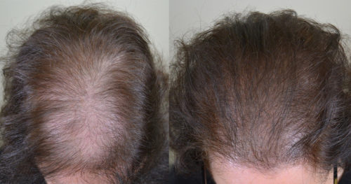  74 year old female underwent 3 sessions of SMP with us in order to help decrease the contrast between her scalp and hair color. 