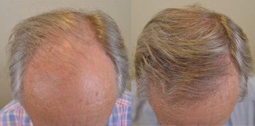 75-Top-Hair-Transplant