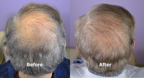 80 year old male before and after hair transplant crown view. FUT harvest. Norwood Class 5 