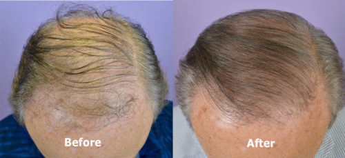 hair transplant Archives - Hair Restoration of the South