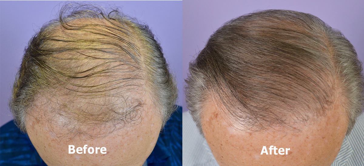 FUT Hair Transplant on 80 Year Old Male - Hair Restoration of the South