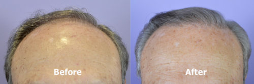 80 year old male hairline before and after hair transplant. FUT harvest. Norwood Class 5 