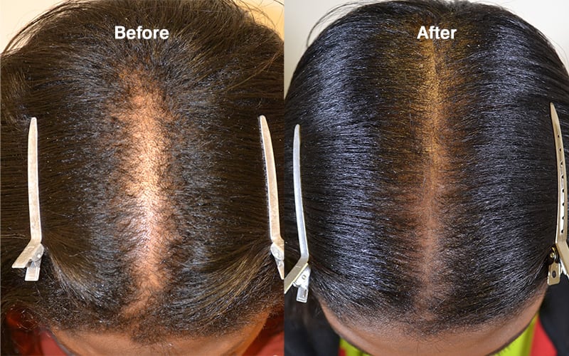 Hair Transplant Before and After Photos: African-Americans - Hair  Restoration of the South - New Orleans, LA