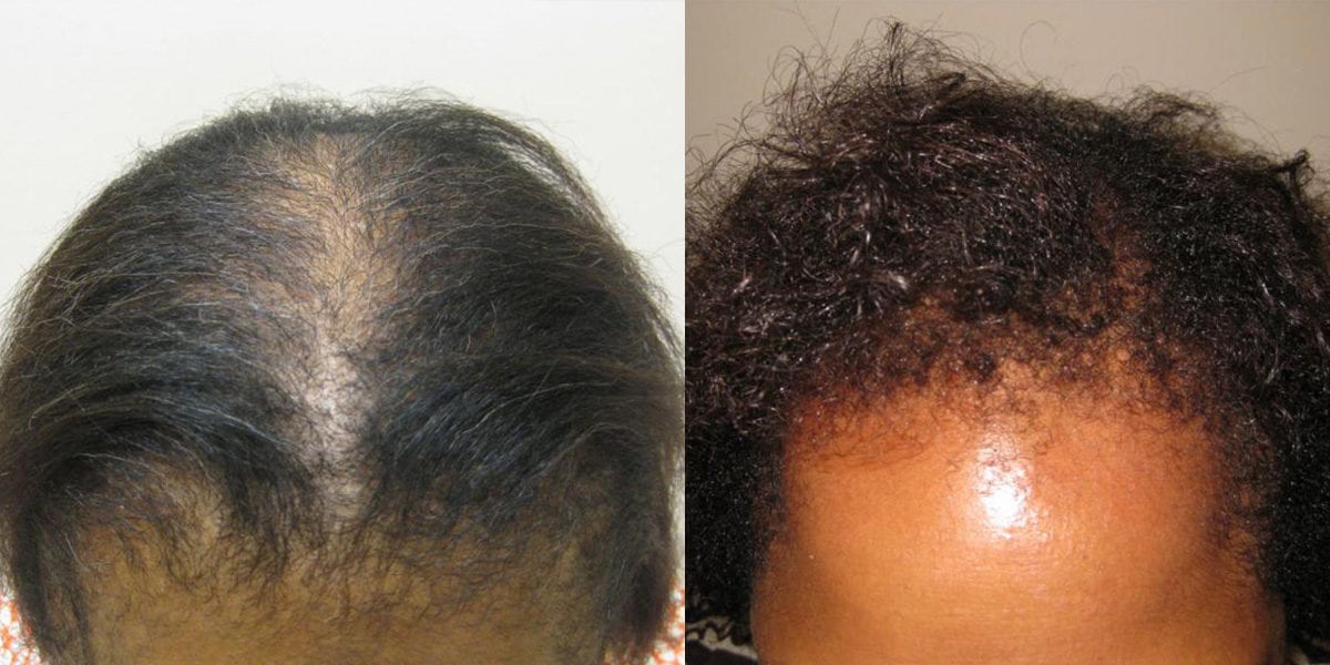 Hair Transplant Before and After Photos: African-Americans - Hair Restoration of the South - New Orleans, LA Hair Transplant Before and After Photos: African-Americans - Hair Restoration of the South - New Orleans, LA