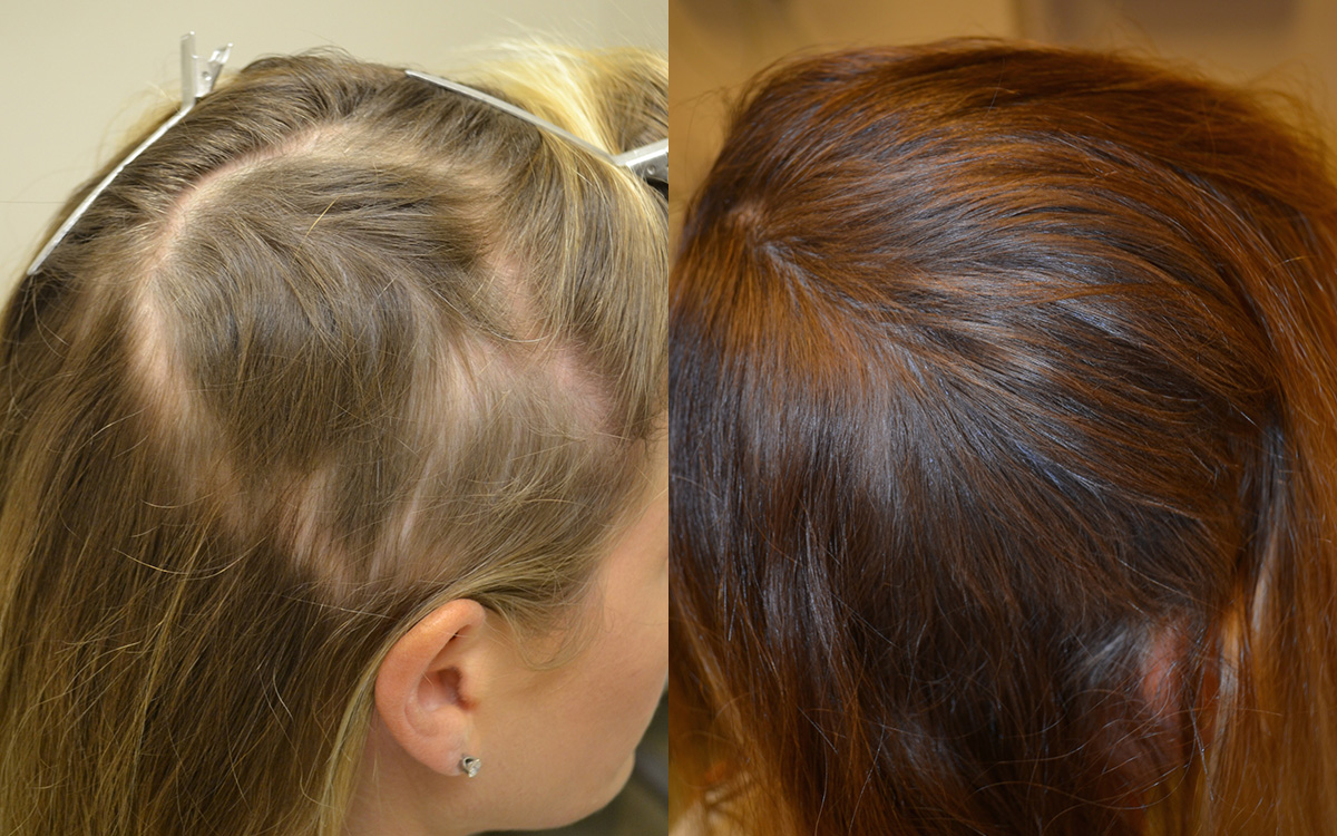Alopecia Areata Treated by PRP Platelet Rich Plasma Hair