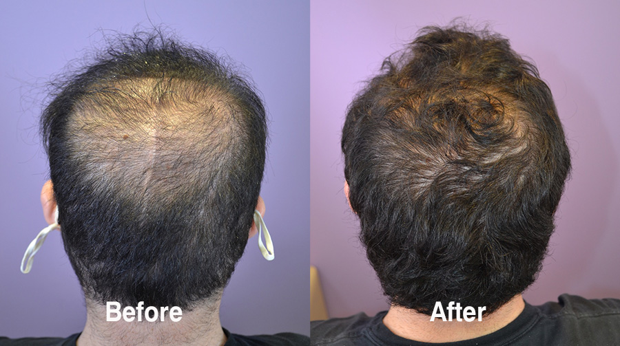 Medical Hair Loss Therapy For 22 Year Old Male With Significant Thinning -  Hair Restoration of the South