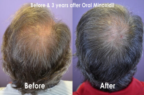 BA-Crown-Oral-Minoxidil-w-Caption