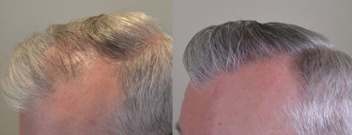 42 YO - 12 FUE Grafts