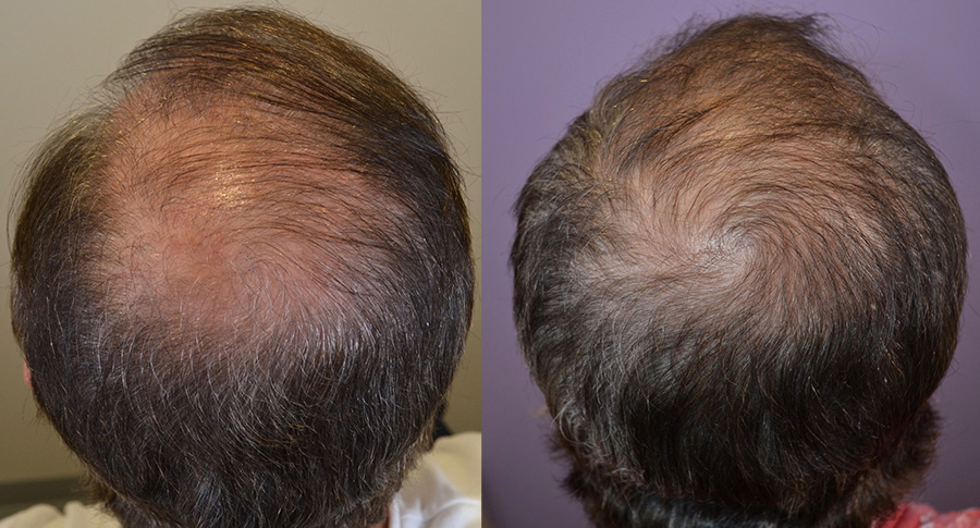 Minoxidil + Finasteride For Crown (Vertex) Hair Loss - Hair Restoration of  the South