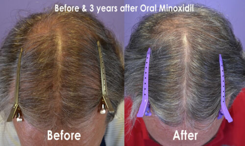 BA-Top-Oral-Minoxidil