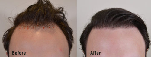 Hair Transplant Before and After Photos: Men - Hair Restoration of the  South - New Orleans, LA