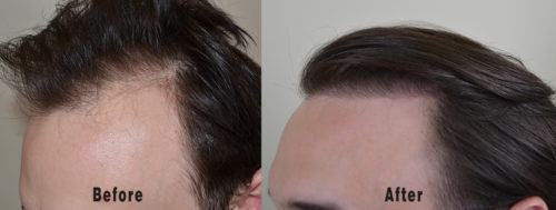 BA_Left-Hair-Transplant