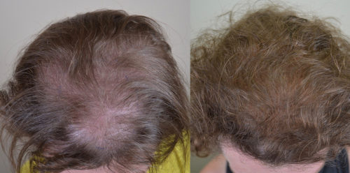 39 year old female who underwent 3 sessions of SMP. - scalp micropigmentation