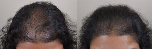 In addition to medical therapy, this 36 year old female is underwent scalp micropigmentation (SMP) for her thinning hair. 