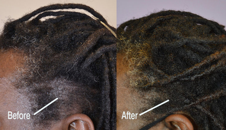 Traction Hair Loss From Braiding - Hair Restoration of the South