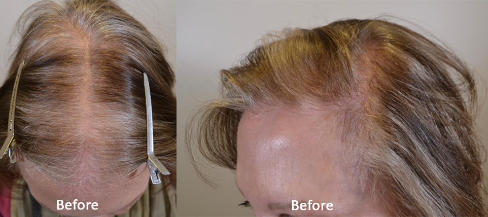 Medical Therapy Hair Transformation Hair Restoration Of The South