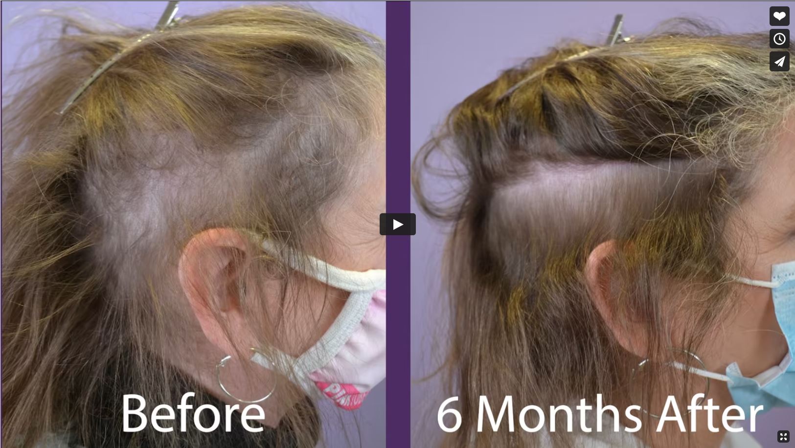 Hair thinning on sides on sale female