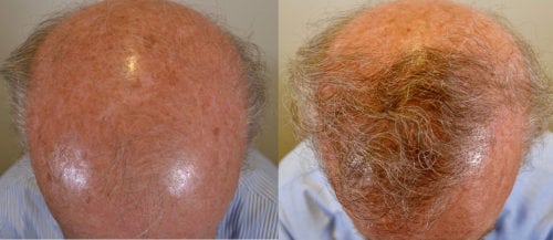 Top view - before and after 1 session of  1937 grafts