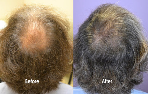 Case Study Archives - Hair Restoration of the South