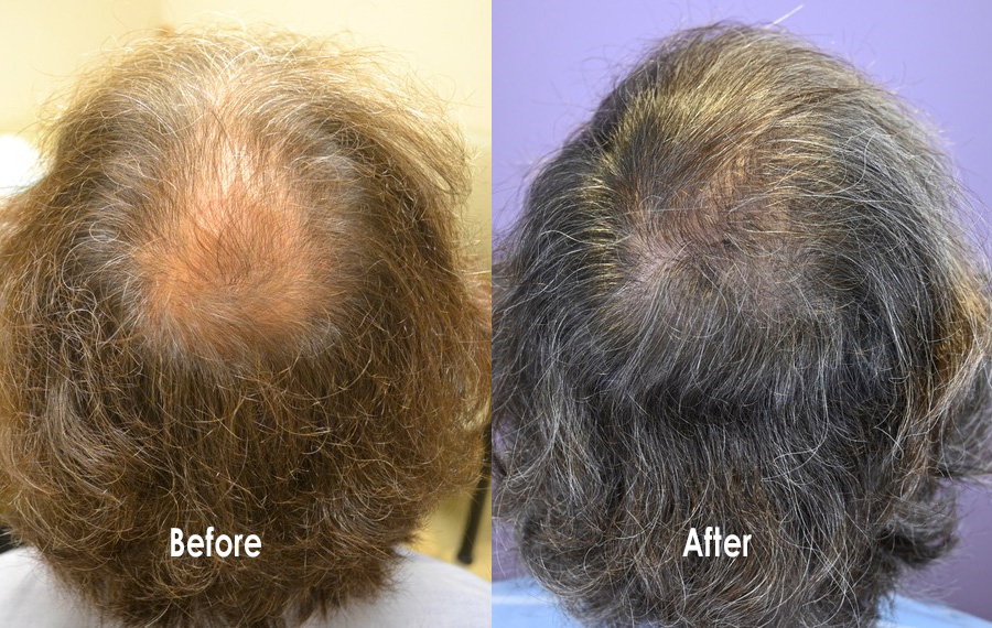 Combination Medical Therapy For Hair Loss - Hair Restoration of the South