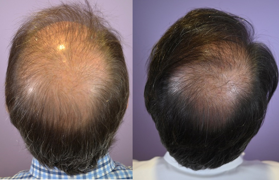 Hair Transplant on 64 Year Old Male with Diffuse Hair Loss - Hair  Restoration of the South