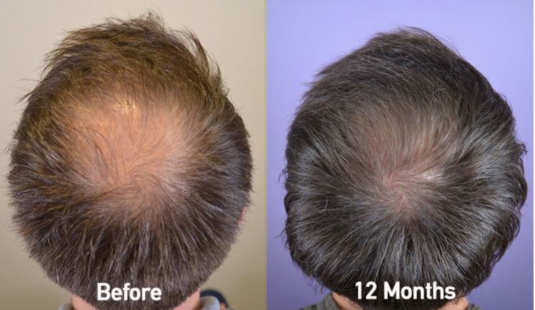 Minoxidil finasterid oder Hair Loss