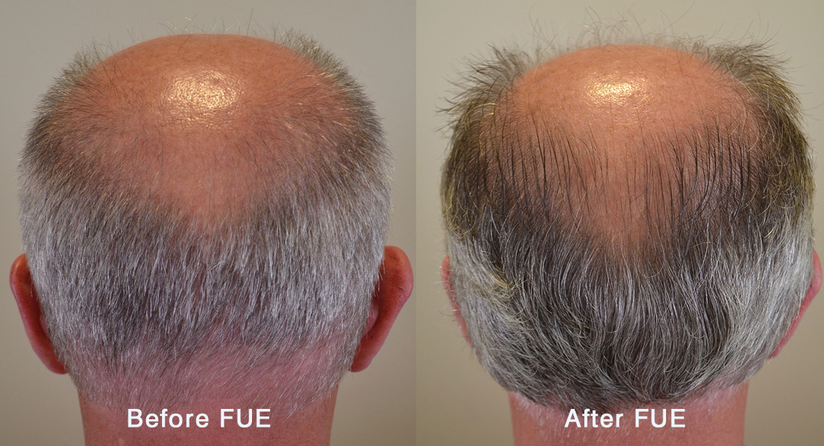 Can Finasteride Improve Your Donor Area Density? - Hair Restoration of the  South