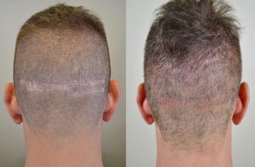 41 year old male who had undergone two previous FUT (strip) surgeries 10 years prior with another clinic.  
He presented for additional hair surgery and to help improve the appearance of the donor area. 
Dr. Rogers first performed an FUE procedure to harvest hairs from the surrounding area and fill in the linear scar. 
She then did 2-3 sessions of scalp micropigmentation (SMP) to further camouflage the scar’s appearance. 
The patient stated that he finally feels comfortable wearing his hair short again!