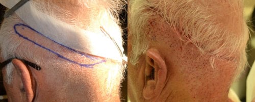 Donor area trimmed before surgery with previous strip scars visible.  After photo, immediately after combination FUE and Strip graft harvesting.