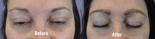 Front view before and 8 moths after eyebrow hair transplant.
