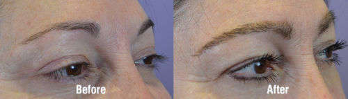 The goal was to add more volume along the superior aspect of her brows.