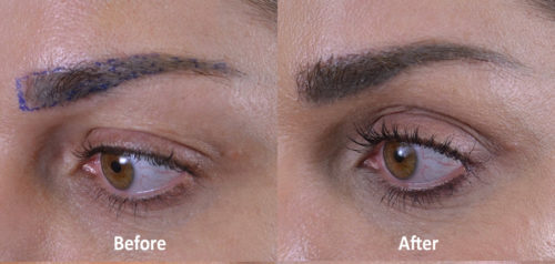 Left side - 35 year old female. She developed smudging from repeat microblading of her eyebrows - she had FUE long hair harvesting with the Mamba. After results are after just 5 months post-op. 