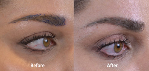 right side - before and 5 months after surgery.