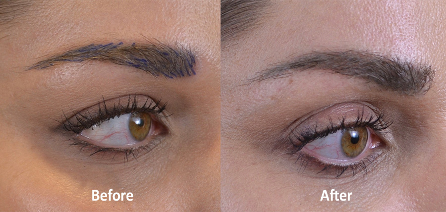 Eyebrow Hair Restoration with Hair Transplant Surgery - Hair Restoration of  the South