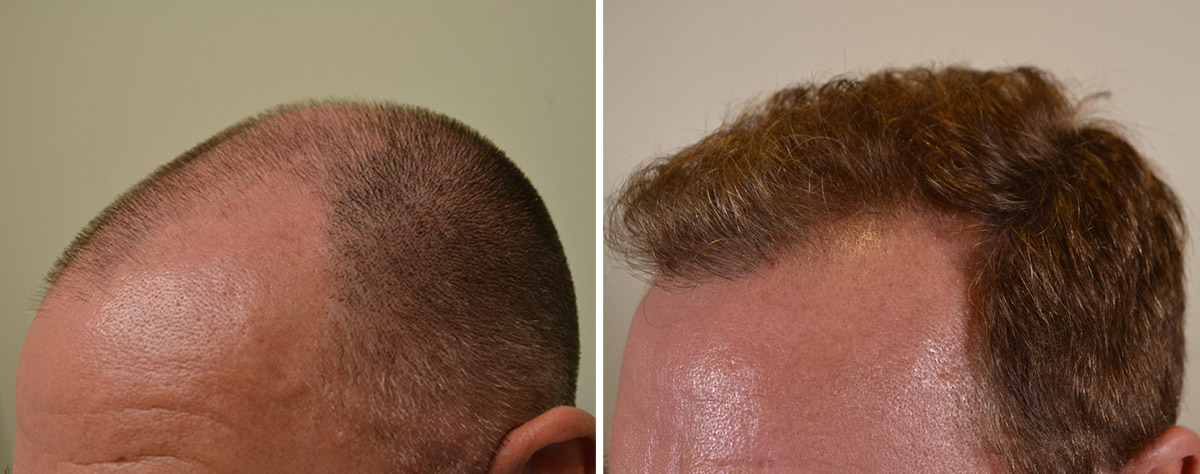 FUE Hair Transplant 1000 Plus Finasteride 1mg Daily - Hair Restoration