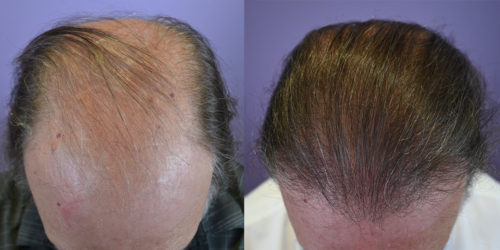 FUT-Hair-Transplant-2