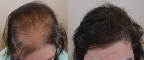 42 year old female underwent SMP 18 months after her hair transplant of 1,576 follicular units
