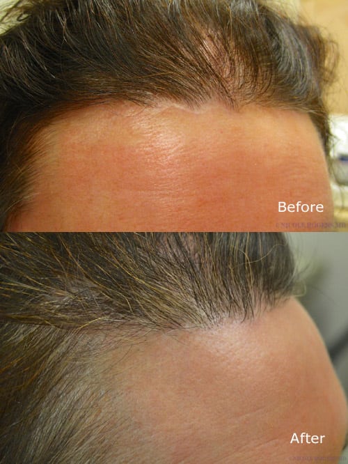 A Facelift scar can also be corrected with hair transplantation.
